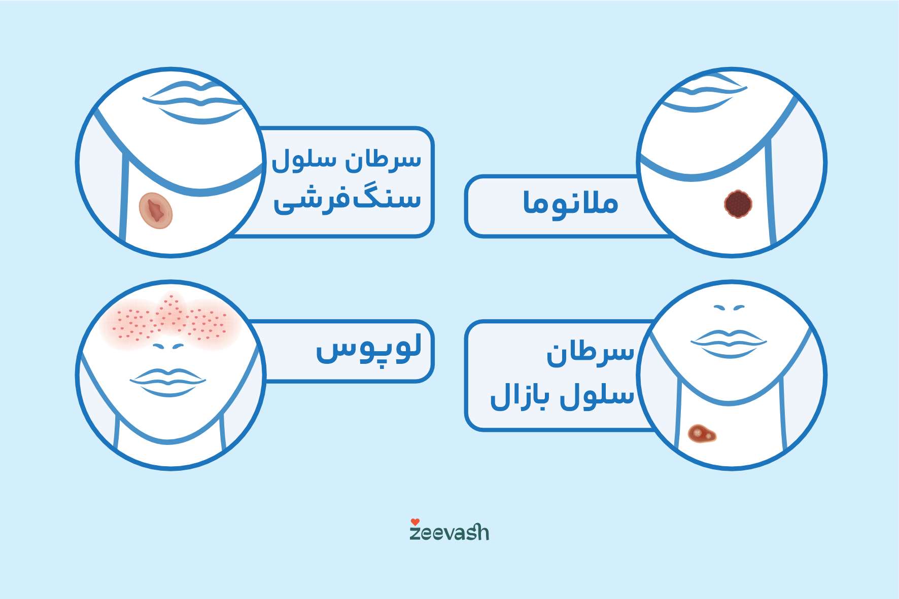 عکس انواع بیماری های پوستی - ملانوما لوپوس بازال سنگ فرشی